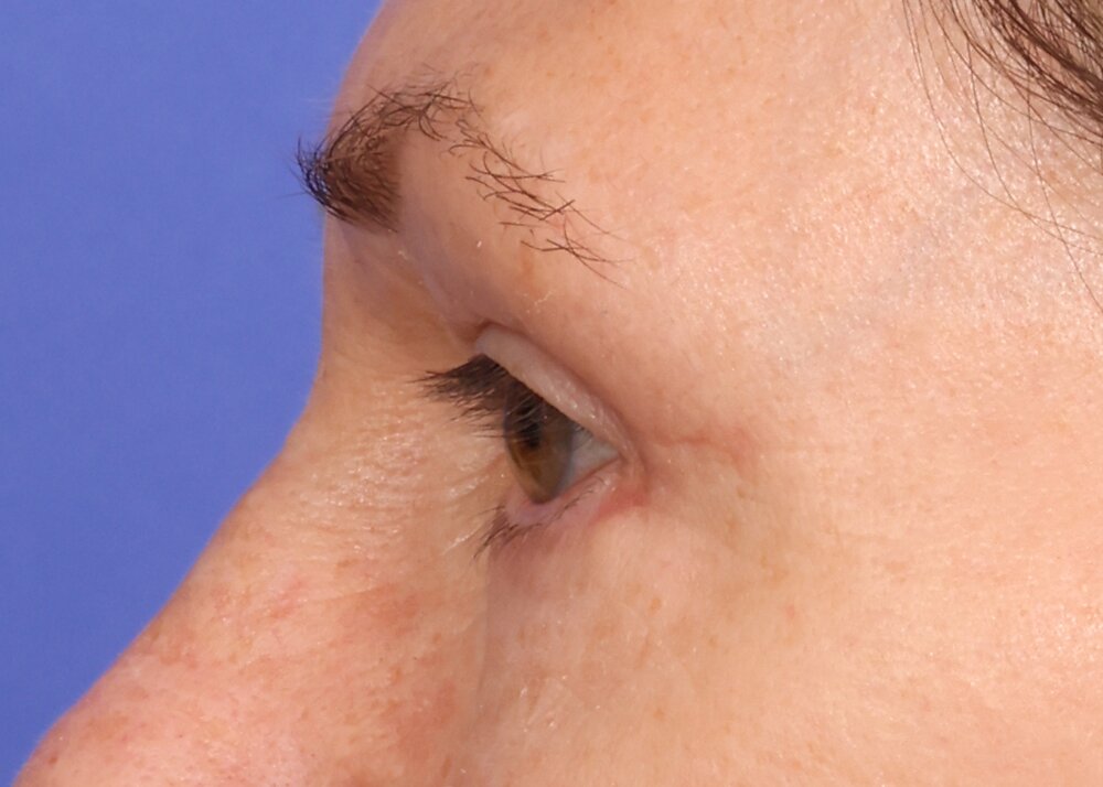 Blepharoplasty Before & After Image