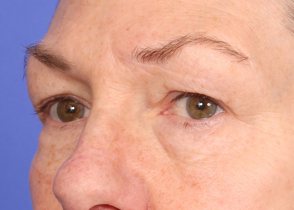 Blepharoplasty Before & After Image