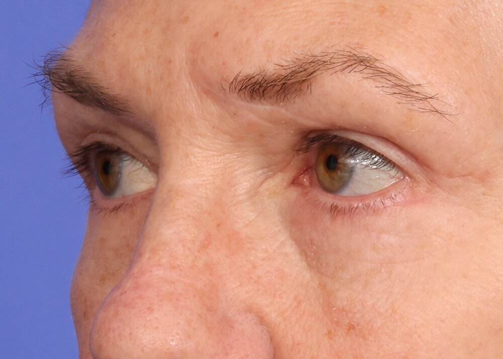 Blepharoplasty Before & After Image