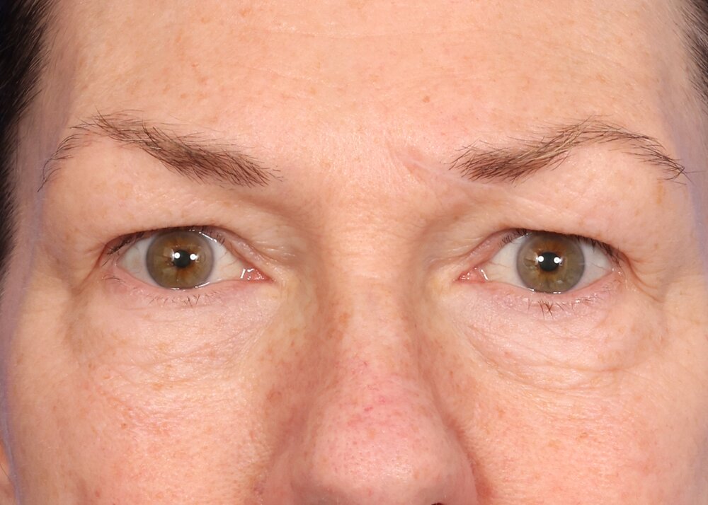 Blepharoplasty Before & After Image