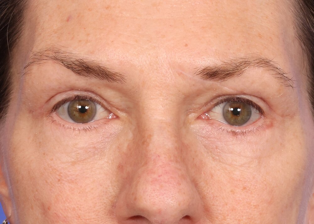 Blepharoplasty Before & After Image