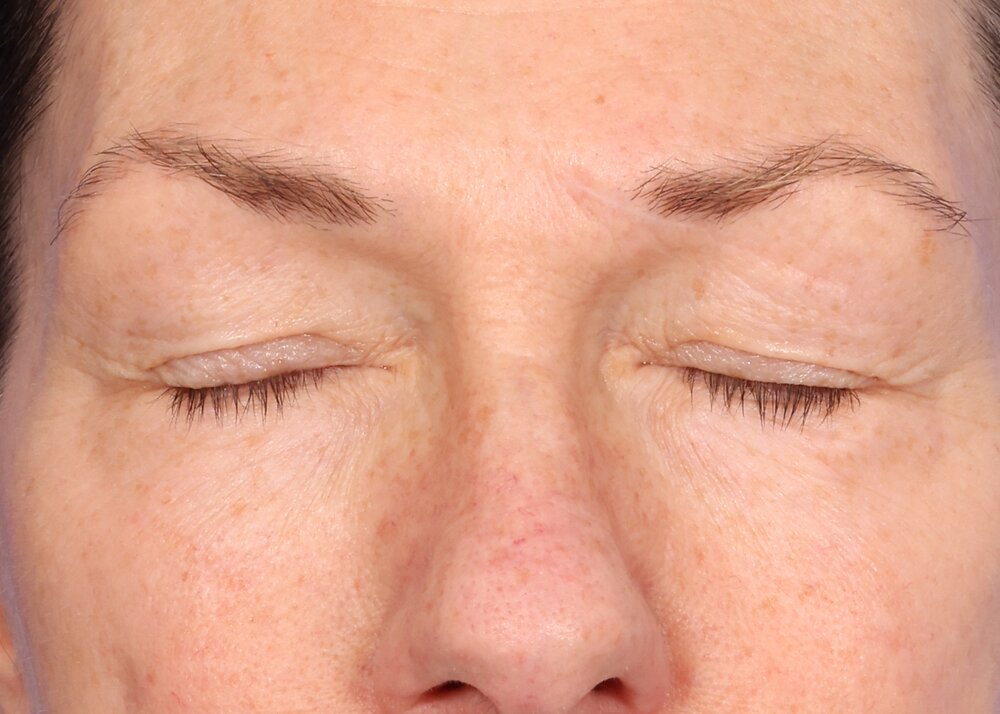 Blepharoplasty Before & After Image