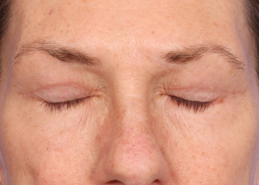 Blepharoplasty Before & After Image