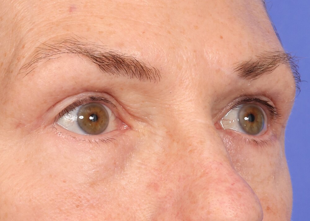 Blepharoplasty Before & After Image