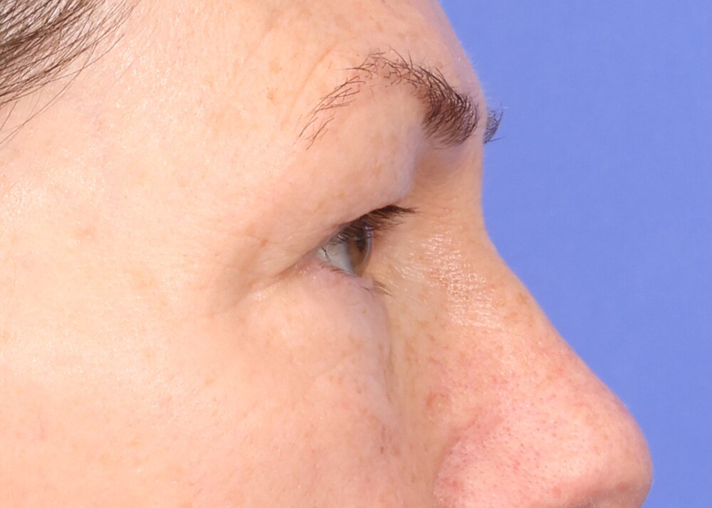 Blepharoplasty Before & After Image