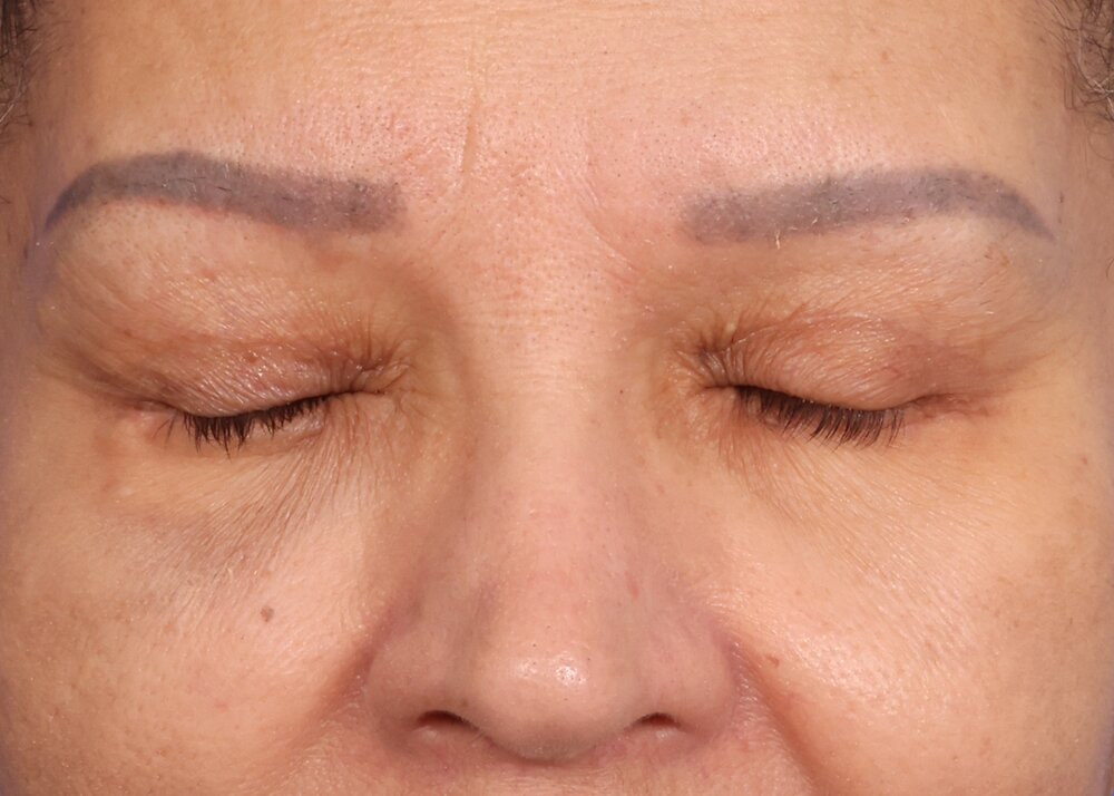 Blepharoplasty Before & After Image