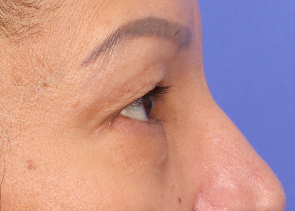 Blepharoplasty Before & After Image