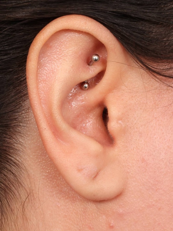 Earlobe Repair Before & After Image