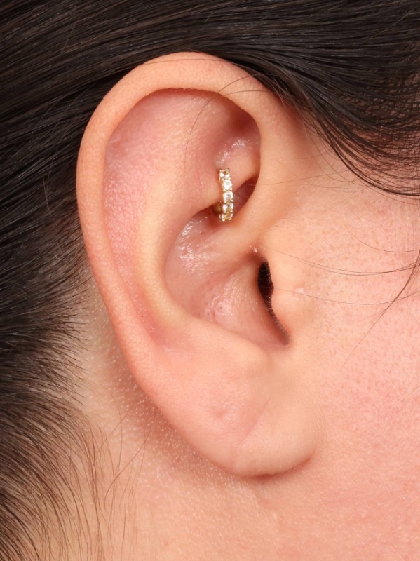 Earlobe Repair Before & After Image