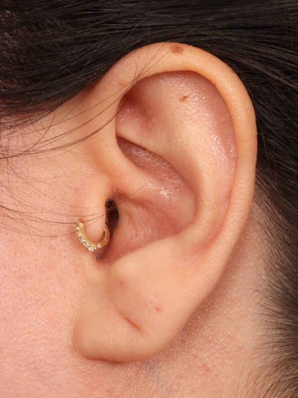 Earlobe Repair Before & After Image