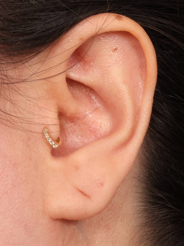 Earlobe Repair Before & After Image