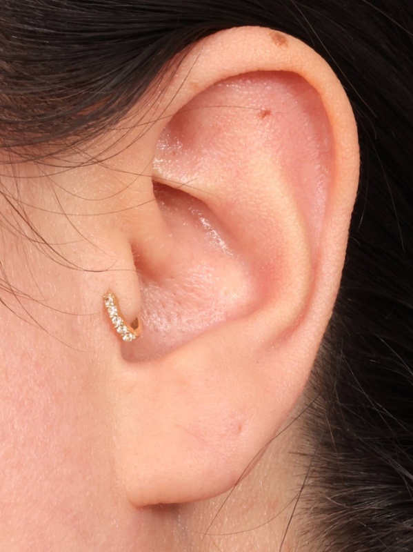 Earlobe Repair Before & After Image