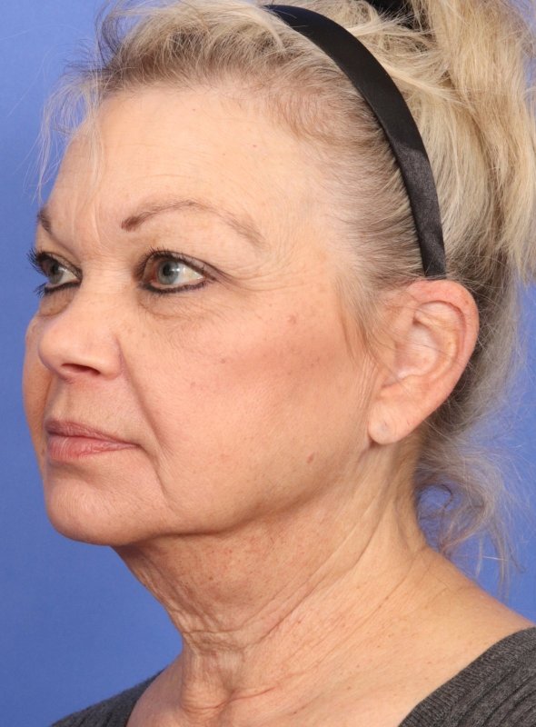 MyEllevate Neck Lift Before & After Image