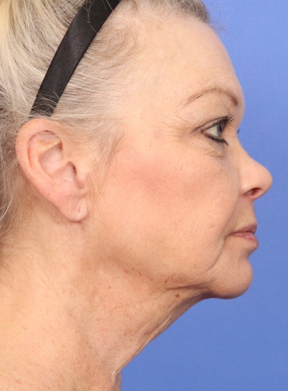 MyEllevate Neck Lift Before & After Image