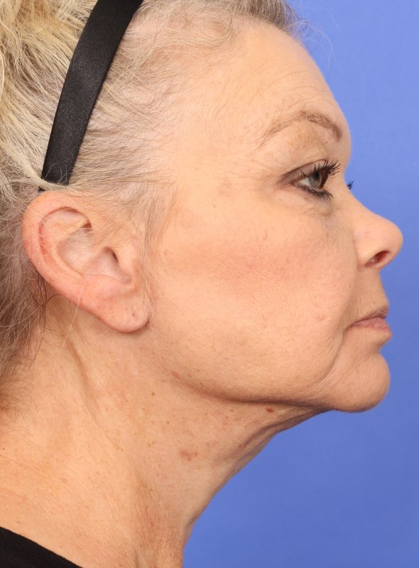 MyEllevate Neck Lift Before & After Image