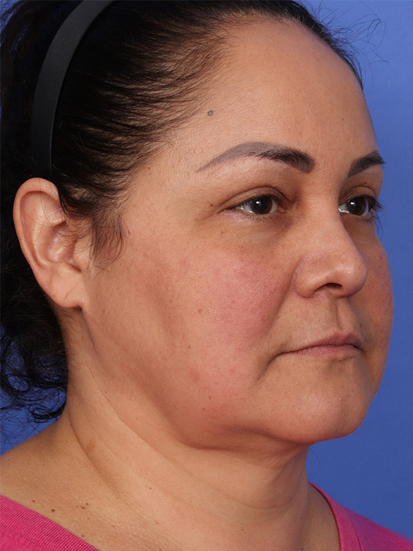 MyEllevate Neck Lift Before & After Image