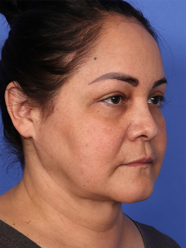 MyEllevate Neck Lift Before & After Image