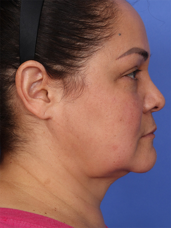 MyEllevate Neck Lift Before & After Image