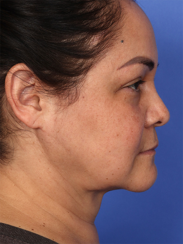 MyEllevate Neck Lift Before & After Image