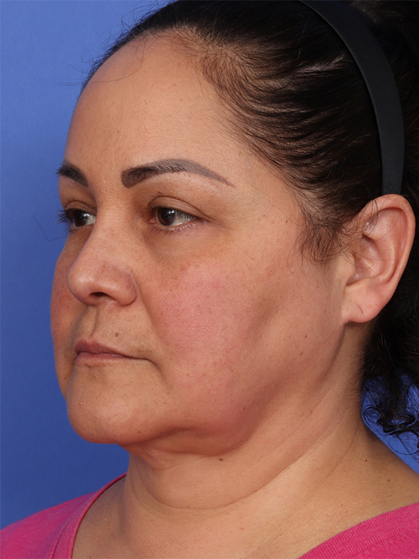 MyEllevate Neck Lift Before & After Image