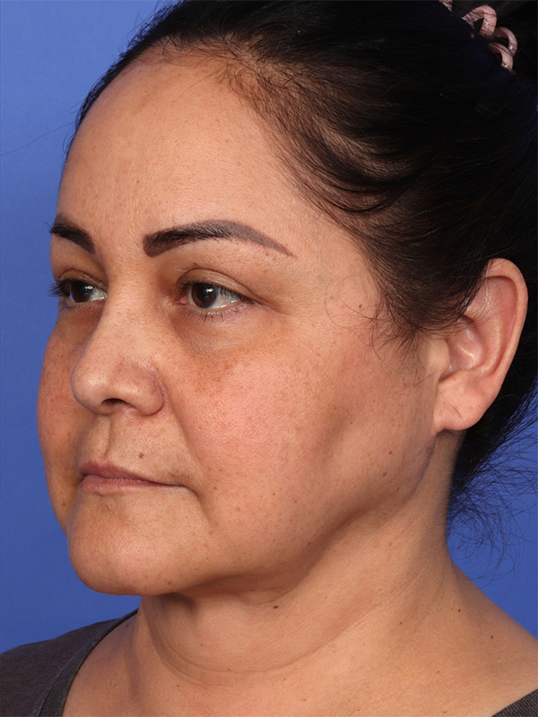 MyEllevate Neck Lift Before & After Image