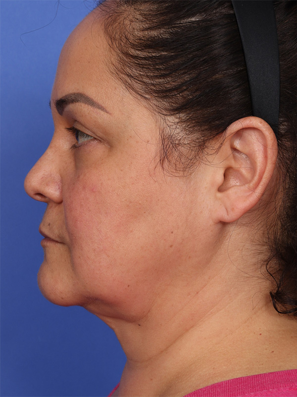 MyEllevate Neck Lift Before & After Image