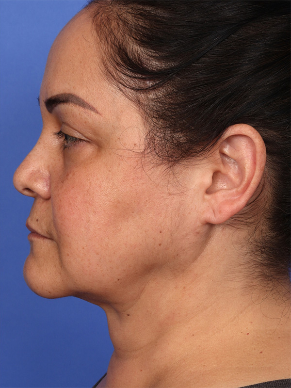 MyEllevate Neck Lift Before & After Image