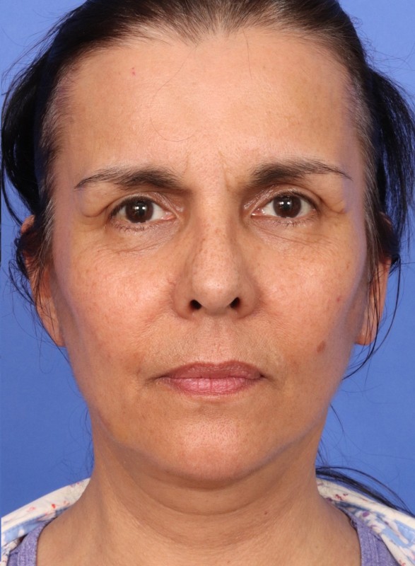 MyEllevate Neck Lift Before & After Image