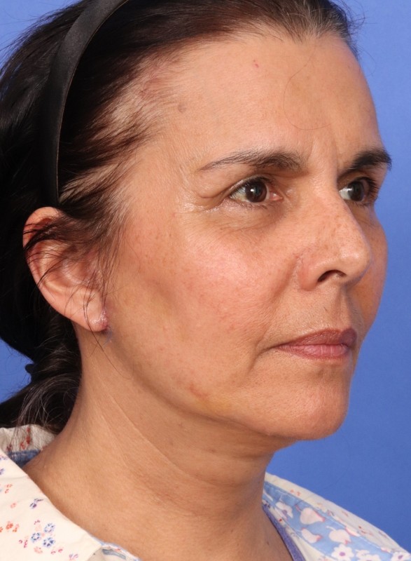 MyEllevate Neck Lift Before & After Image