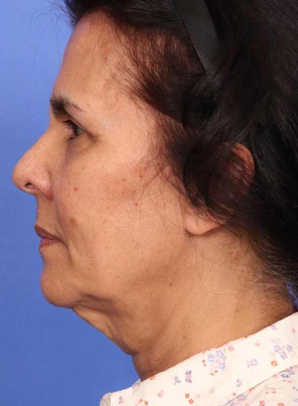 MyEllevate Neck Lift Before & After Image