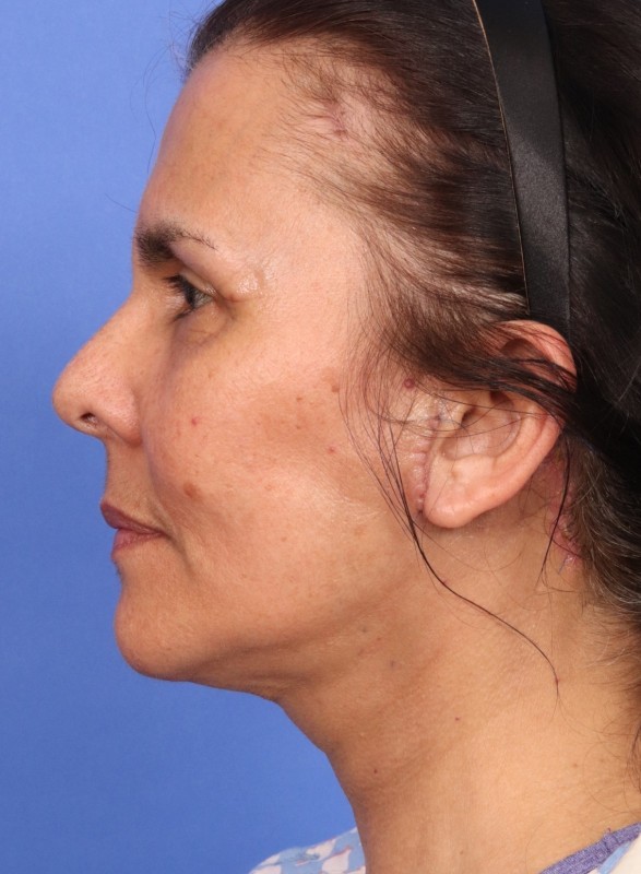 MyEllevate Neck Lift Before & After Image