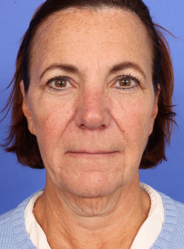 MyEllevate Neck Lift Before & After Image