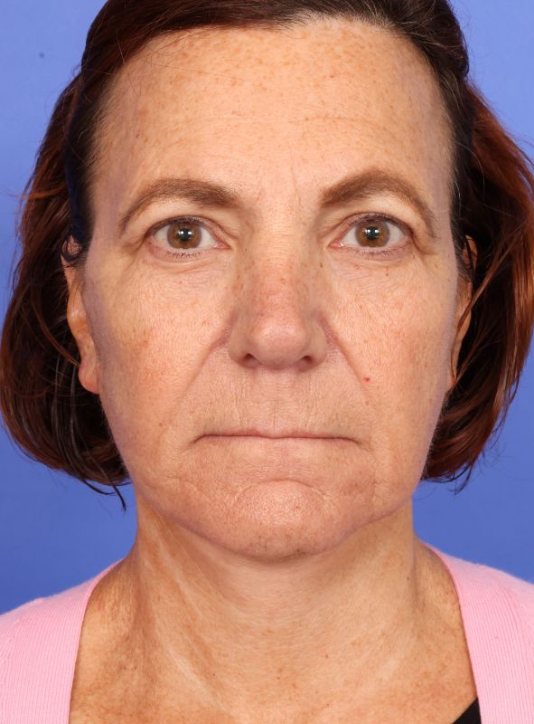 MyEllevate Neck Lift Before & After Image