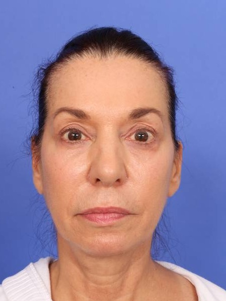MyEllevate Neck Lift Before & After Image