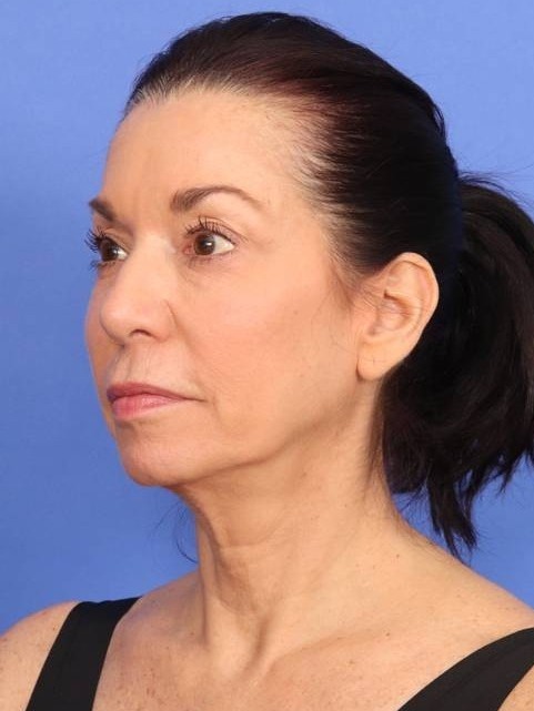 MyEllevate Neck Lift Before & After Image