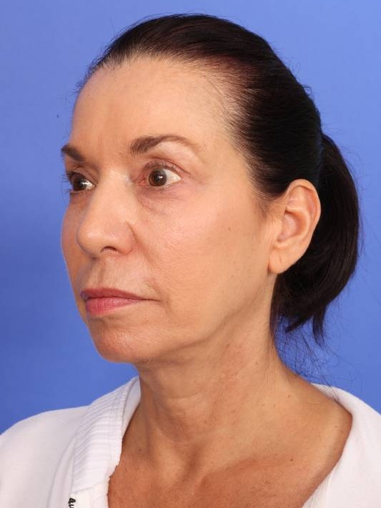 MyEllevate Neck Lift Before & After Image