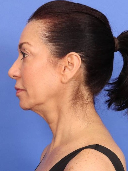 MyEllevate Neck Lift Before & After Image