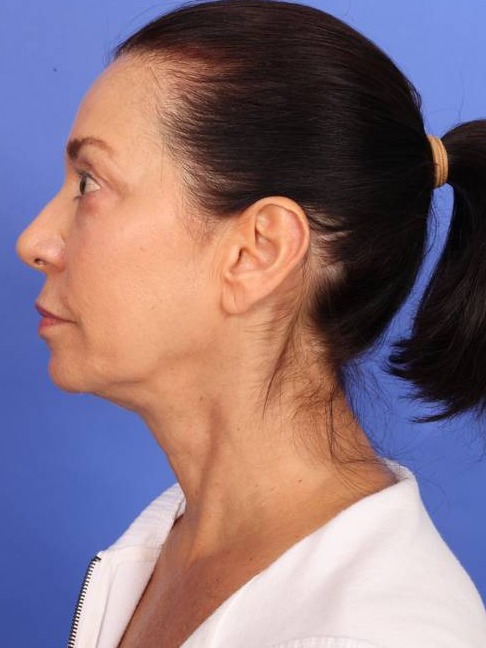 MyEllevate Neck Lift Before & After Image