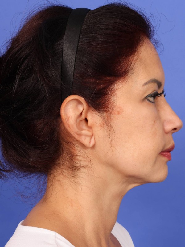 MyEllevate Neck Lift Before & After Image