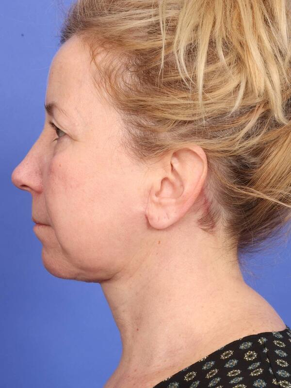 MyEllevate Neck Lift Before & After Image