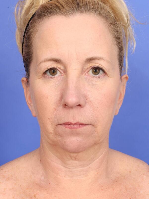 MyEllevate Neck Lift Before & After Image