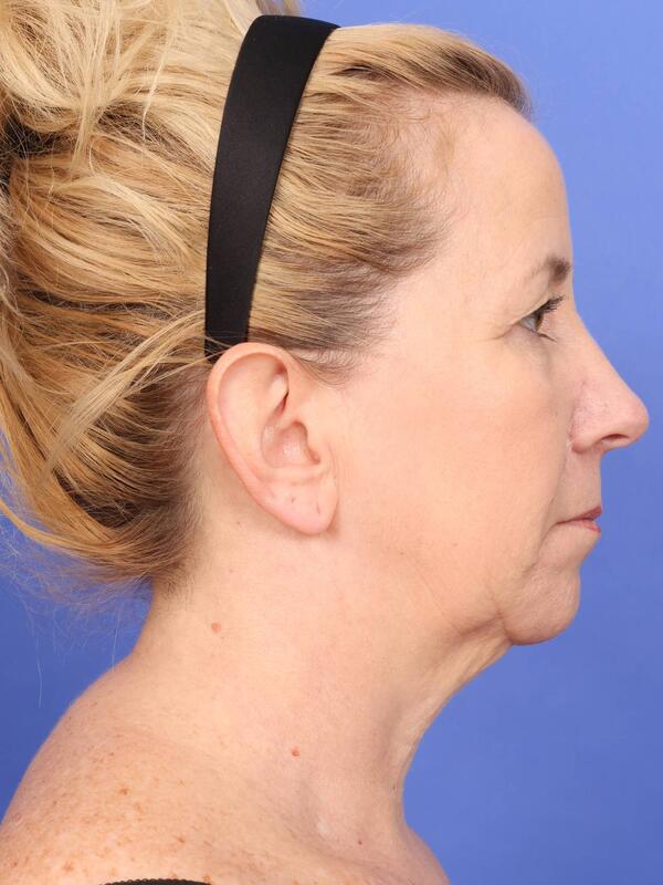 MyEllevate Neck Lift Before & After Image