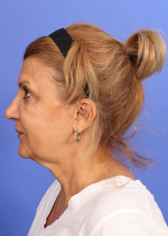 MyEllevate Neck Lift Before & After Image