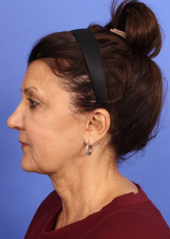 MyEllevate Neck Lift Before & After Image