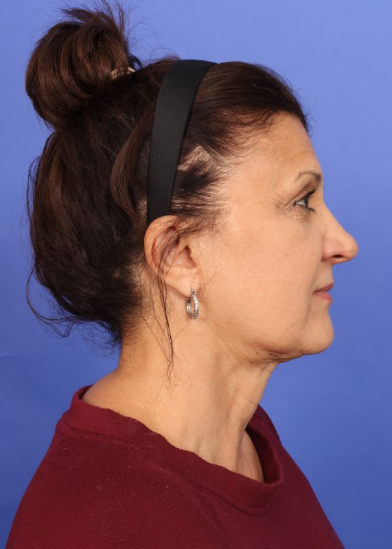 MyEllevate Neck Lift Before & After Image