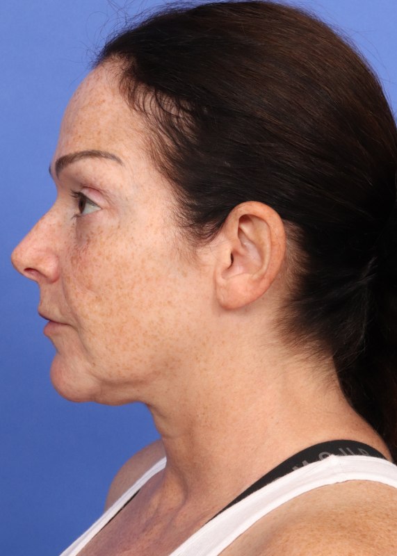 MyEllevate Neck Lift Before & After Image