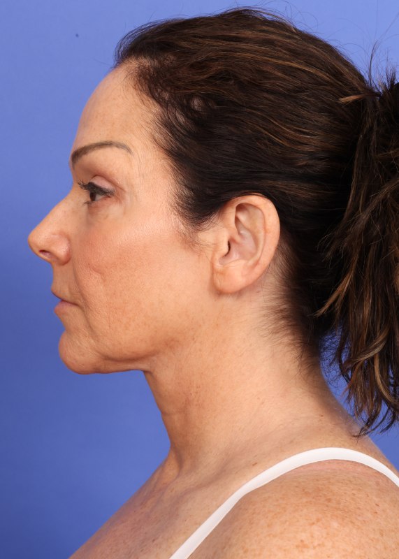 MyEllevate Neck Lift Before & After Image