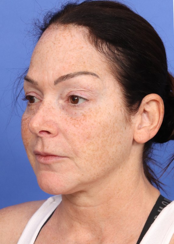 MyEllevate Neck Lift Before & After Image