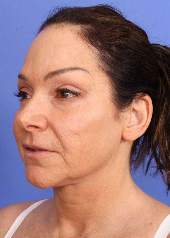 MyEllevate Neck Lift Before & After Image