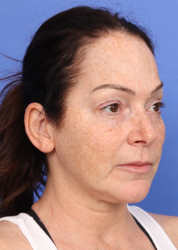 MyEllevate Neck Lift Before & After Image